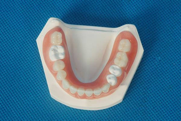 Acrylic Denture + Cusil mn502